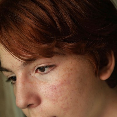 woman with red face