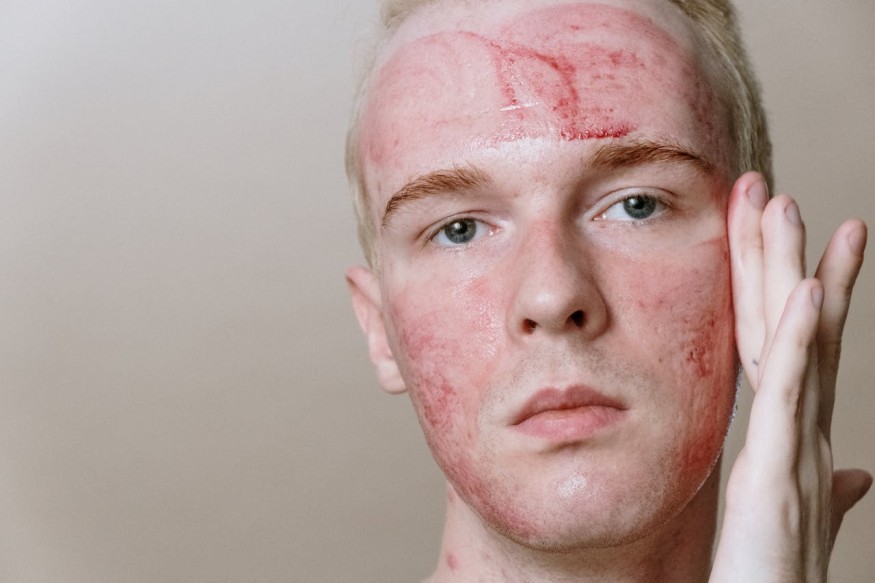Man with reddish face