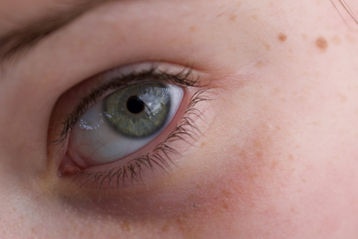 Dermatologists Teach You How To Get Rid of Milia On Your Face