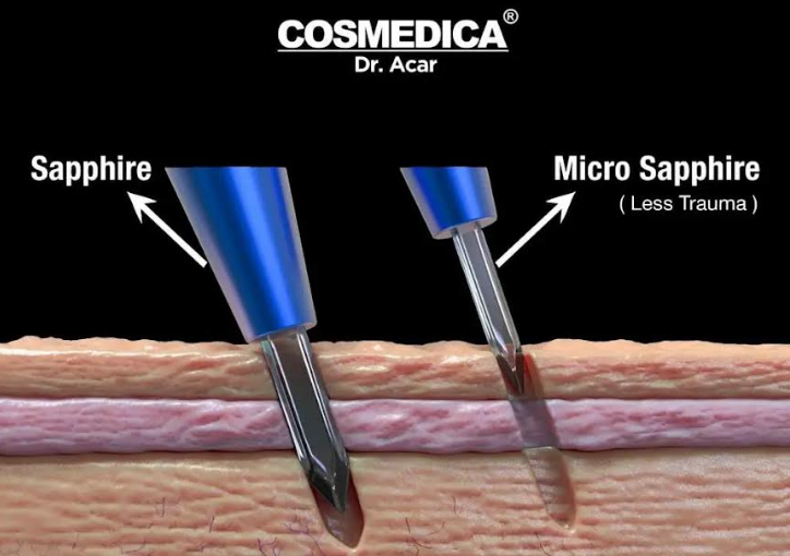 Hair Transplant Before and After - Success Rate