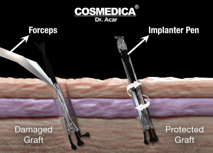 Hair Transplant Before and After - Success Rate
