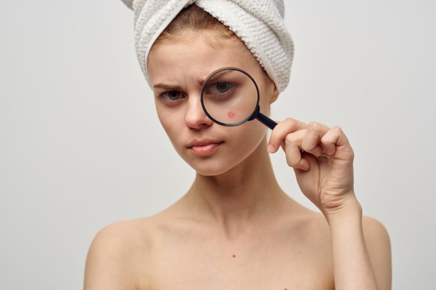 Pimple Patches: How They Work