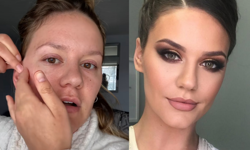 TikTokers Introduce 'Cheaper Alternative' to Botox With Just the Use of Tape — Does It Really Work?